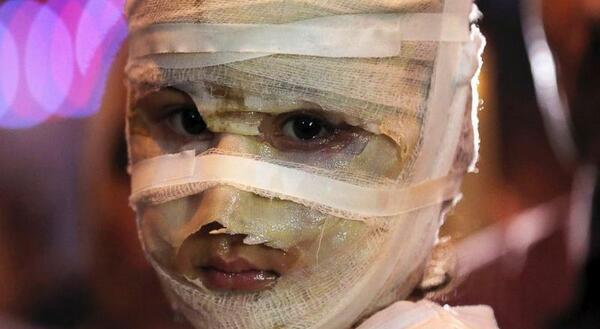 عکس بچه صورت زخمی