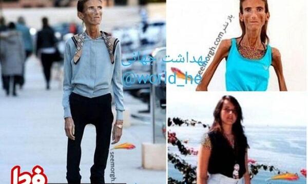 عکس لاغر ترین بچه جهان