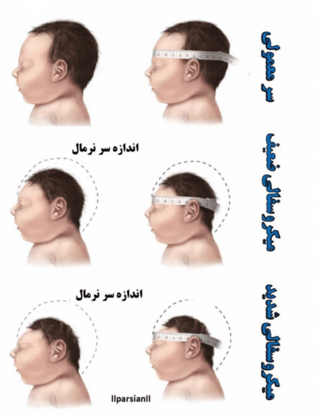 عکس بچه های میکروسفالی