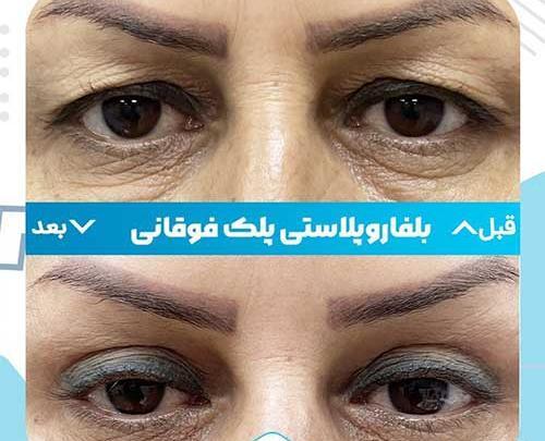 عکس برداری چشم اهواز