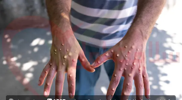 عکس آبله ی میمونی