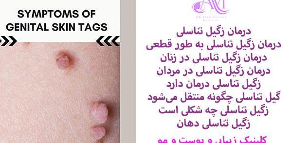 عکس زگیل تناسلی زنان در کشاله ران