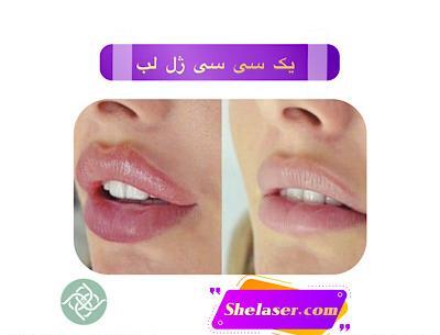 عکس روز اول تزریق ژل لب