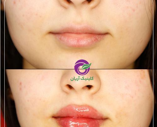 عکس روز اول تزریق ژل لب