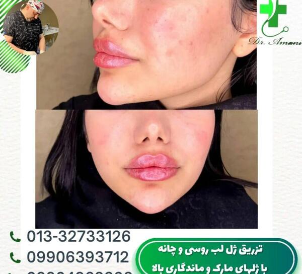 عکس روز اول تزریق ژل لب