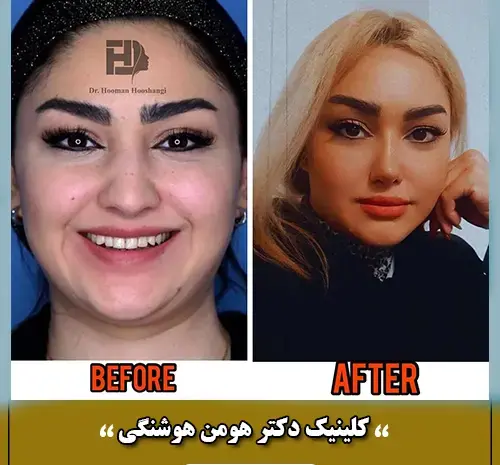 عکس های روز اول عمل بینی