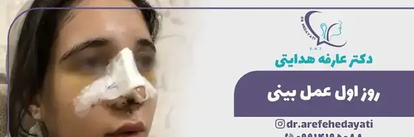 عکس های روز اول عمل بینی