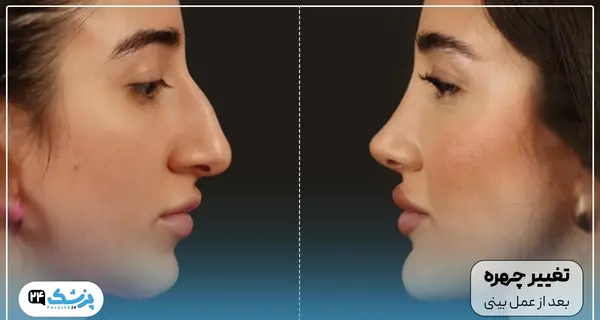 عکس های روز اول عمل بینی
