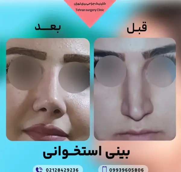 عکس های روز اول عمل بینی