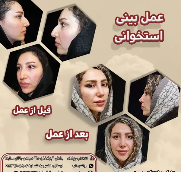 عکس های روز اول عمل بینی
