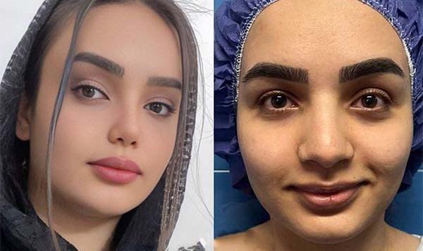 عکس های روز اول عمل بینی