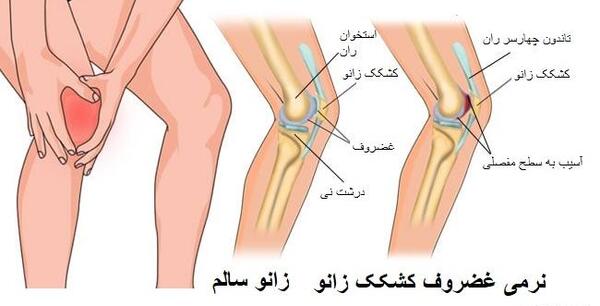 عکس ورزش زانو درد