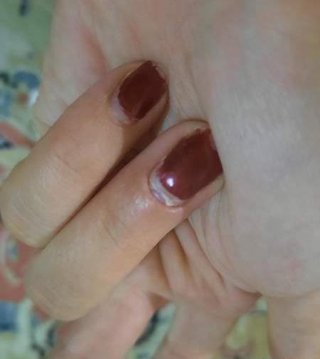 عکس قطره کانازول برای قارچ ناخن