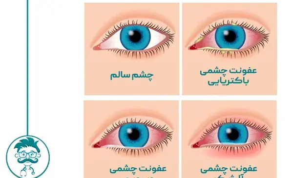عکس چشم درد کودکان