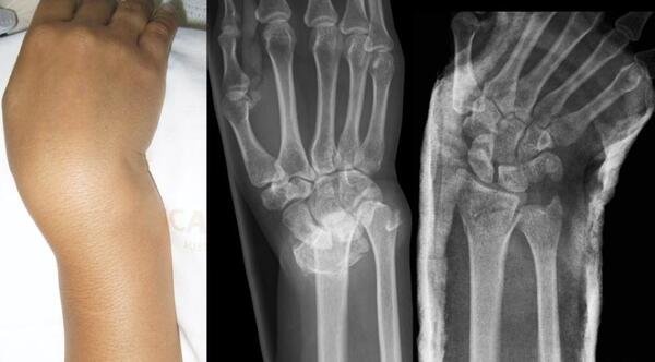 عکس فیک دخترونه دست شکسته