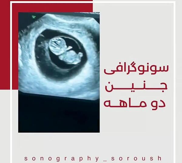 عکس جنین دو ماهه دختر