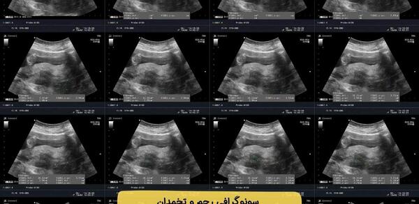 عکس سقط جنین در پریودی
