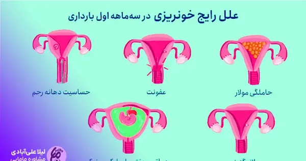 عکس سقط جنین در ماه اول