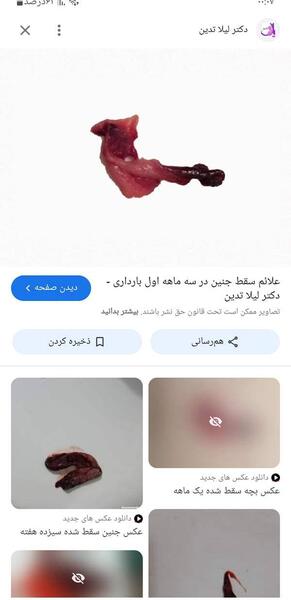 عکس سقط جنین در ماه اول