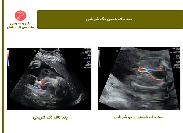 عکس جنین تک شریانی