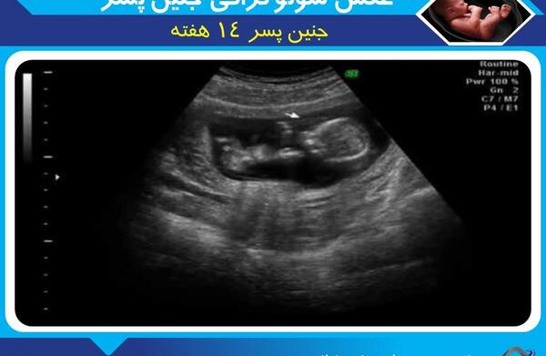 عکس جنین پسر در هفته ۱۷