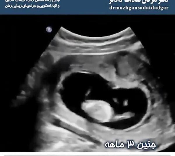 عکس از جنین سه ماهه
