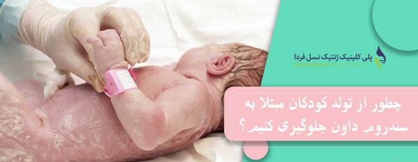 سقط عکس جنین مبتلا به سندروم داون