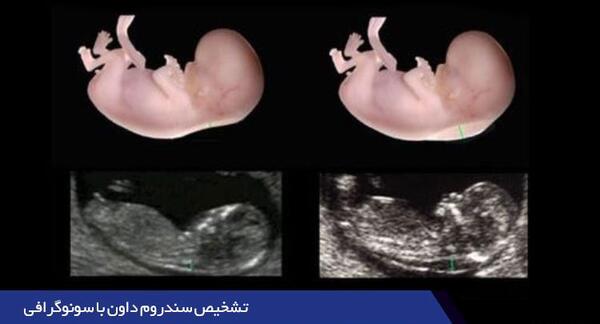 سقط عکس جنین مبتلا به سندروم داون