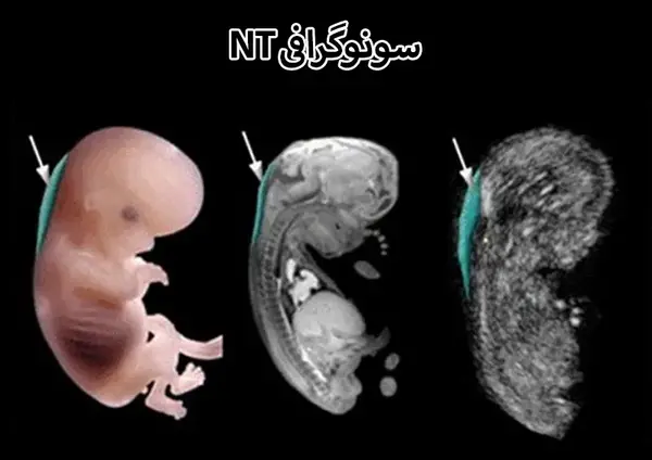 سقط عکس جنین مبتلا به سندروم داون