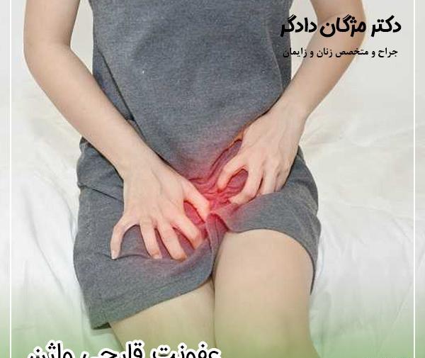 عکس برفک دهانه واژن