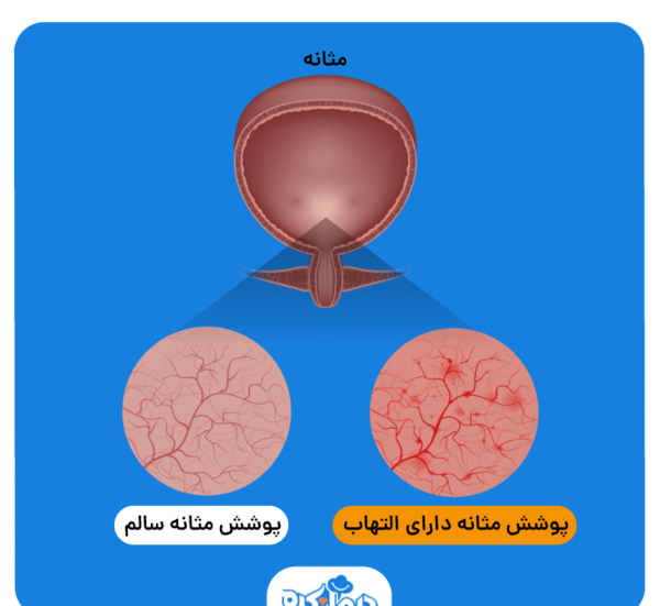عکس مثانه