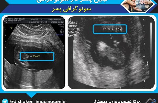 عکس ناف جنین پسر