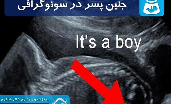 عکس ناف جنین دختر