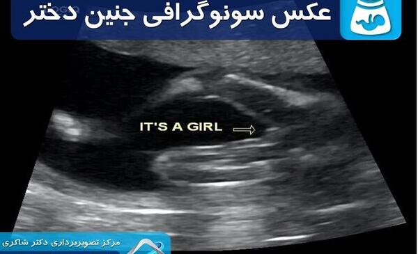 عکس ناف جنین دختر