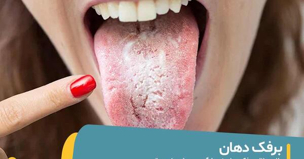 عکس از برفک دهان نوزاد