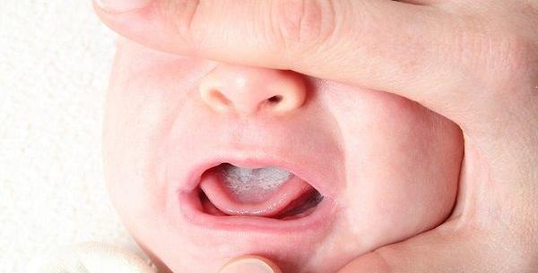 عکس از برفک دهان نوزاد