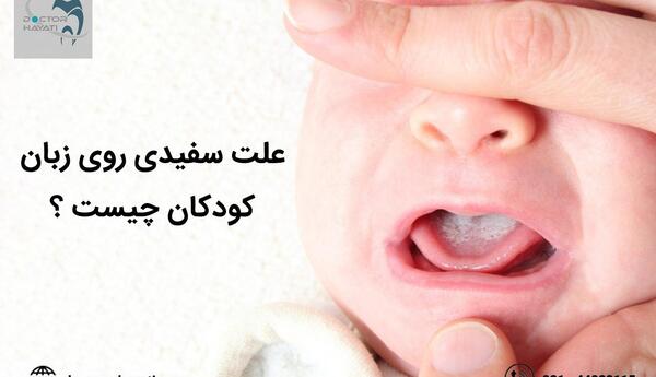عکس برفک سقف دهان نوزاد