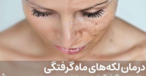 عکس خال مادرزادی
