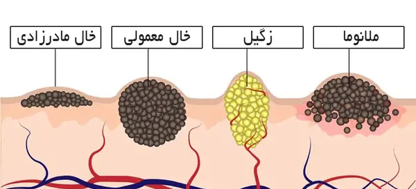 عکس خال مادرزادی