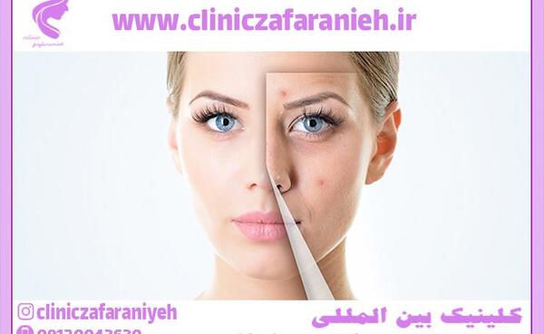 عکس خال مادرزادی
