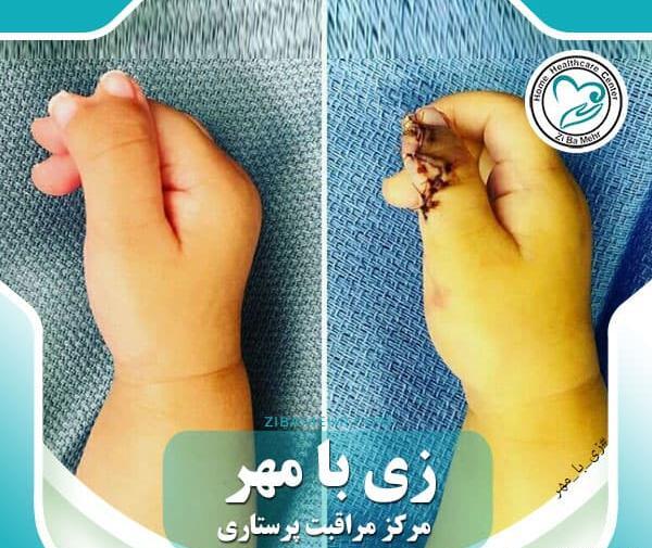 عکس دست مادرزادی