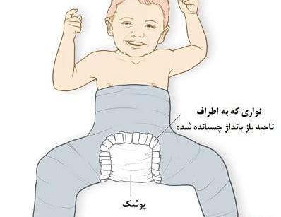 عکس دررفتگی مادرزادی مفصل لگن