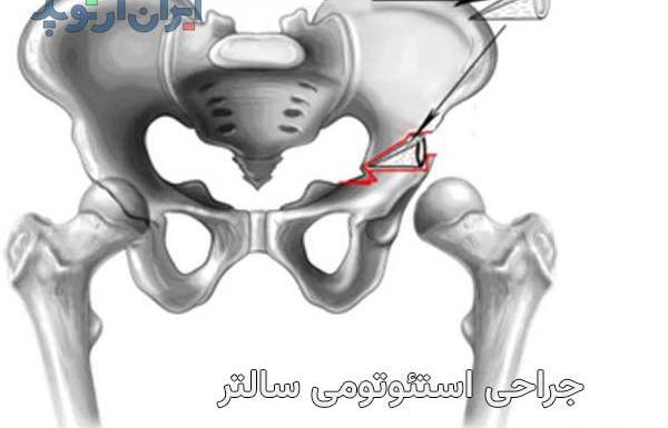 عکس دررفتگی مادرزادی مفصل لگن