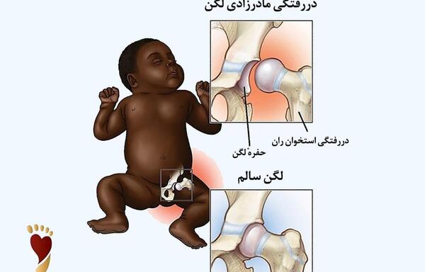 عکس دررفتگی مادرزادی مفصل لگن