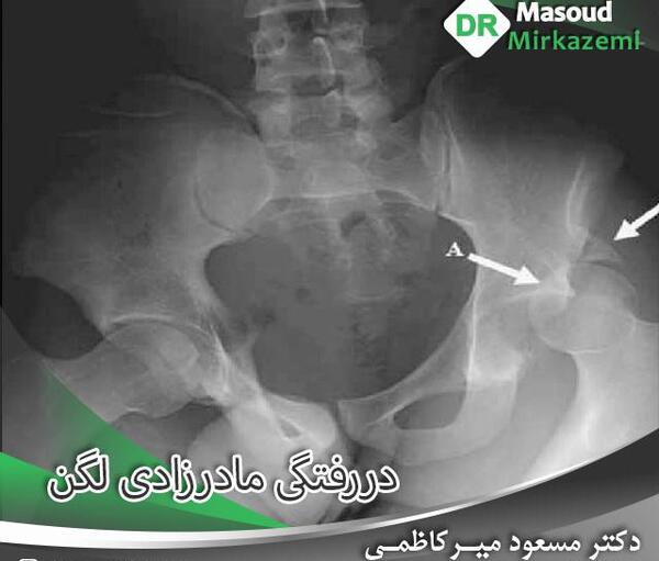 عکس دررفتگی مادرزادی مفصل لگن