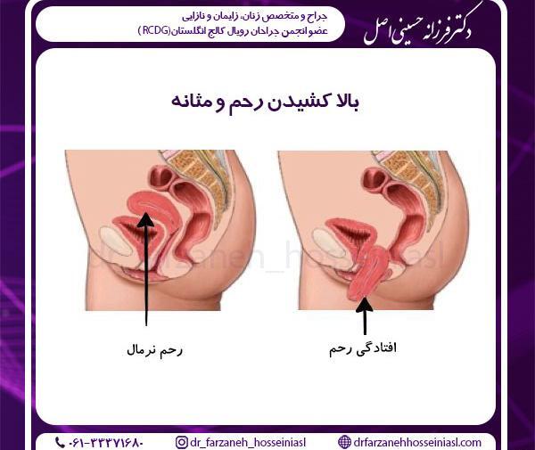 عکس عمل زیبایی مثانه زنان