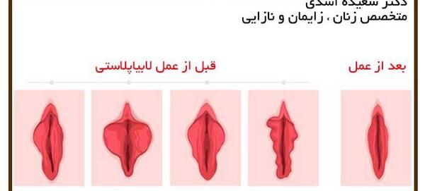 عکس عمل زیبایی مثانه زنان