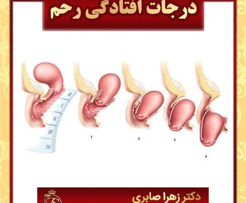 عکس عمل زیبایی مثانه زنان