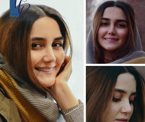 عکس مریم معصومی بعد از عمل بینی