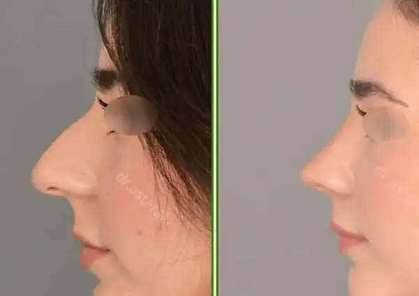 عکس آتلیه ای برای عمل بینی